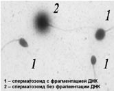 К чему приводит повышенный уровень фрагментации ДНК сперматозоидов